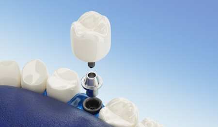 how are done Dental Implants in Turkey